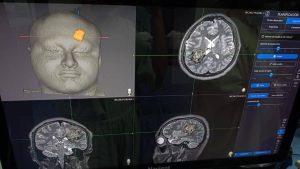 Histórico avance médico en Yucatán: IMSS realiza la primera cirugía cerebral en adolescente despierto